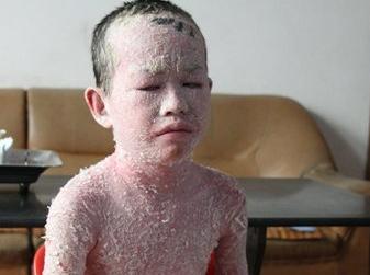 出汗对牛皮癣患者有益吗