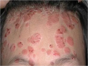 在广州进行牛皮癣治疗大概需要多少钱