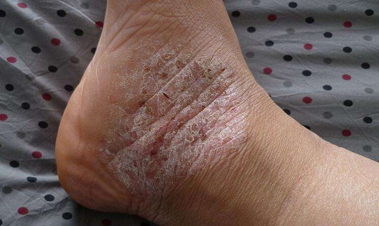 牛皮癣保养有什么需要注意的呢