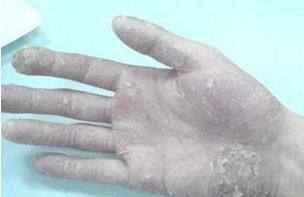 睡眠质量提不高导致银屑病反复发作,如何摆脱复发死循环