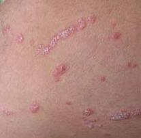 外用药治疗牛皮癣效果好不好