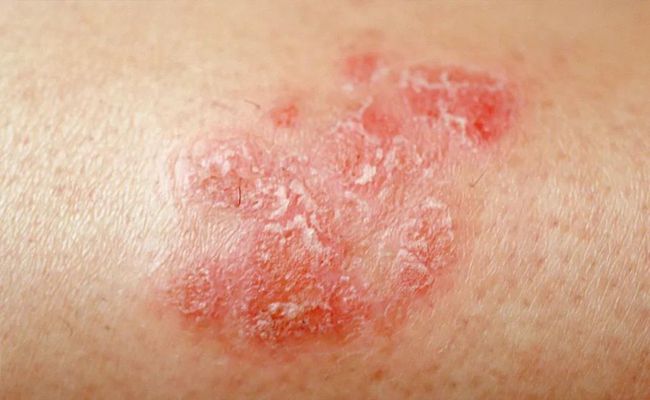 脓疱型牛皮癣的治疗方法有哪些呢