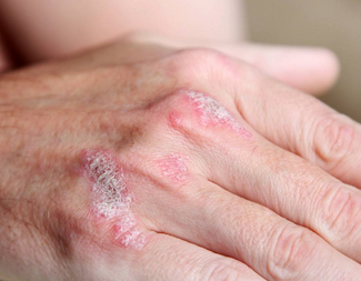 牛皮癣患者如何维持心理健康