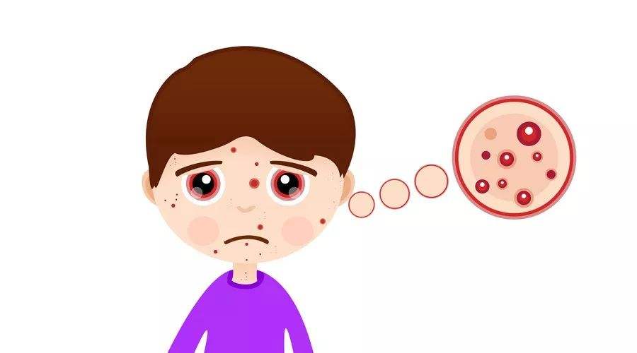 快来看孩子患上牛皮廯的缘由小讲堂