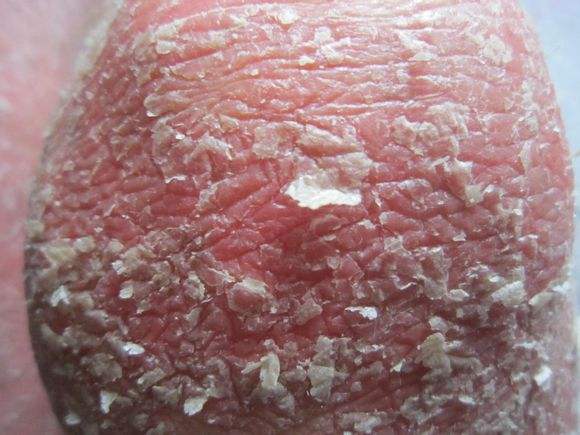 大腹便便有可能你已经患上了牛皮癣