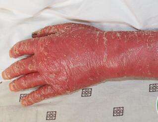 牛皮癣开始全身脱皮是什么时期