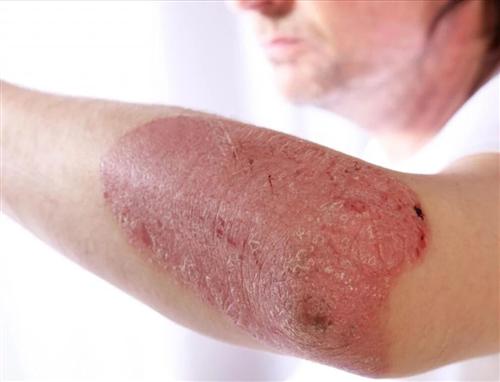 临床上广州专家是如何治疗银霄病的呢