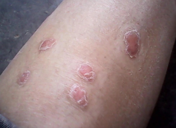 秋季牛皮癣患者注意事项有哪些