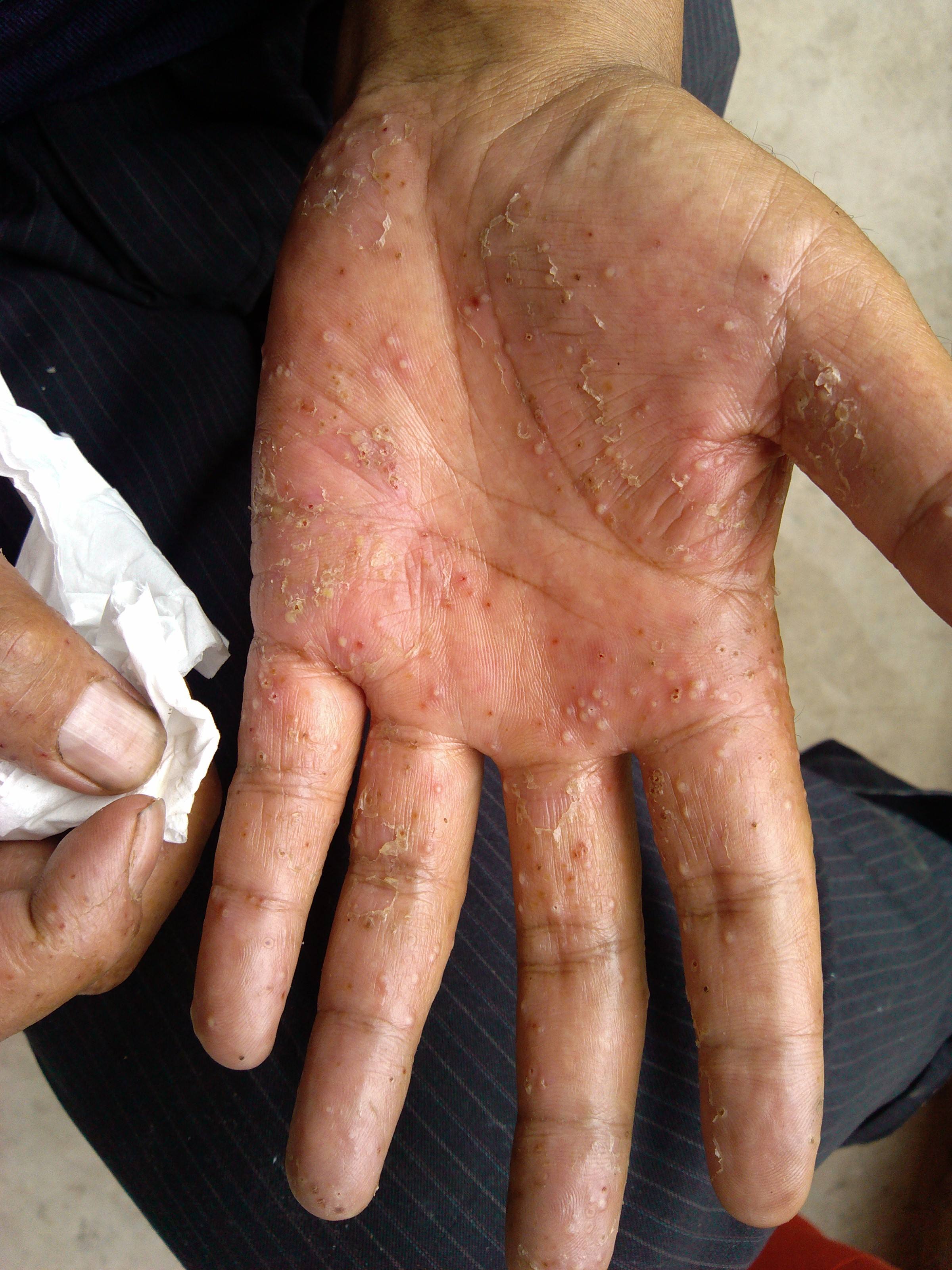 儿童牛皮癣患者的养护方法有哪些