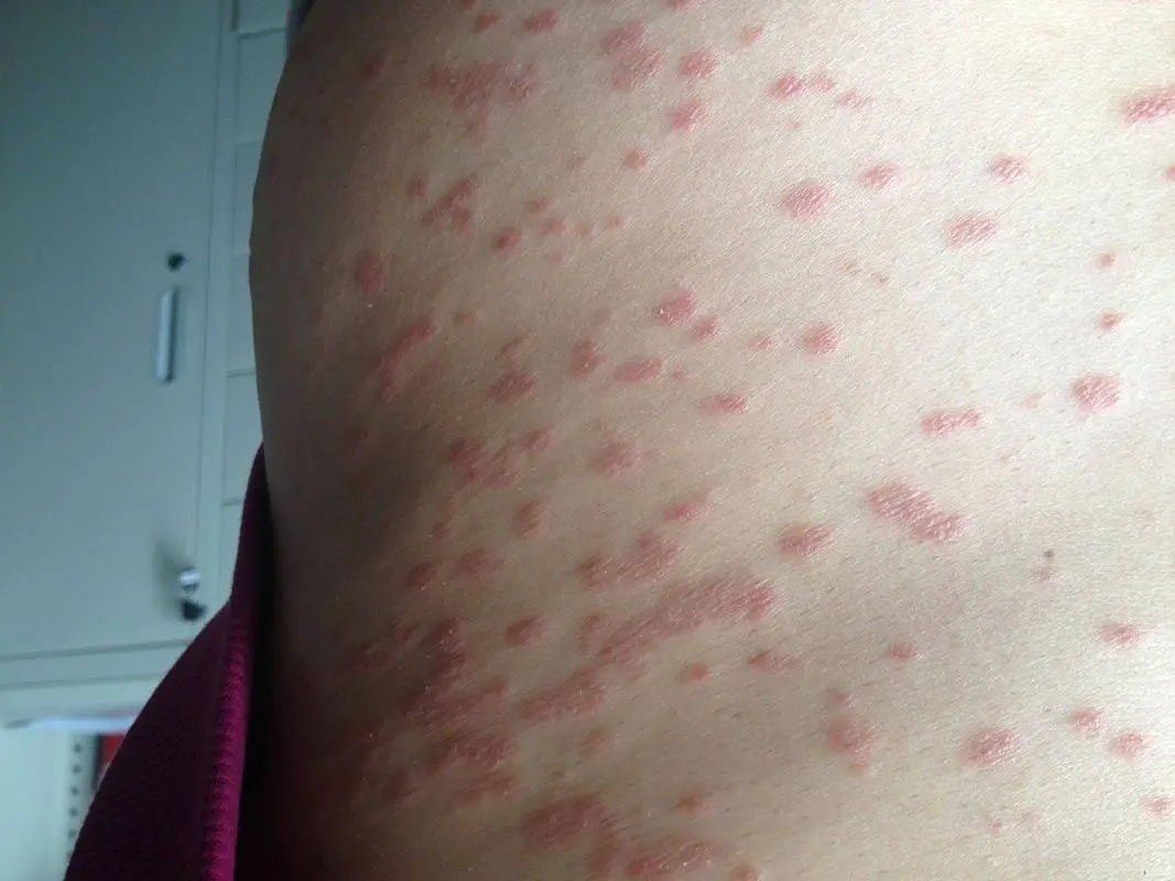 身上出现脱屑瘙痒是患上牛皮癣了吗