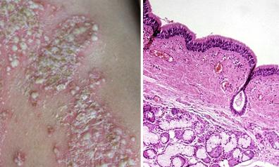 寒冬来袭如何预防银屑病