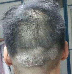 头部牛皮癣会出现哪些症状