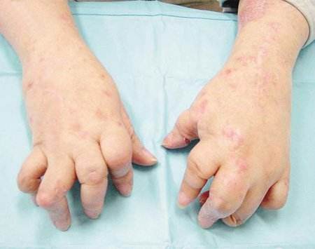 患上牛皮癣后患者们可以吃的食物是有哪些