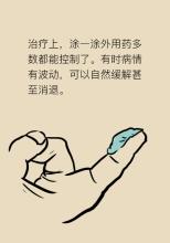 广州哪家医院治疗银屑病见效快