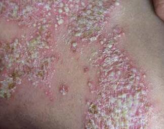 冬季牛皮癣患者的皮肤为何总是干燥起皮