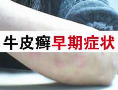 以免夜长梦多-关注牛皮癣早期病症