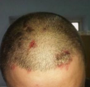 患有牛皮癣这个疾病有什么药物是需要用的