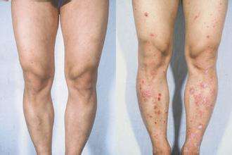 牛皮癣会不会因为压力大加重