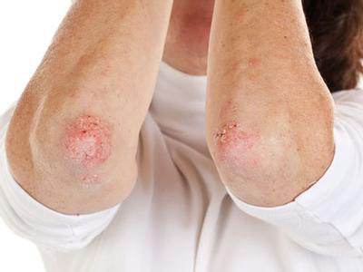 患上牛皮癣这个疾病患者们需要怎么护理呢