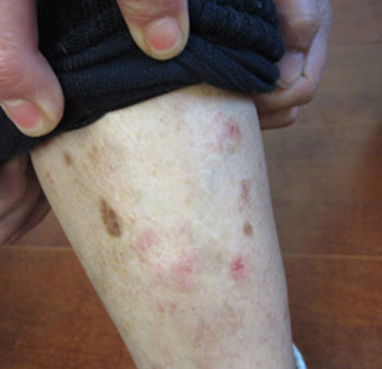 牛皮癣发作之后为什么会瘙痒如何缓解