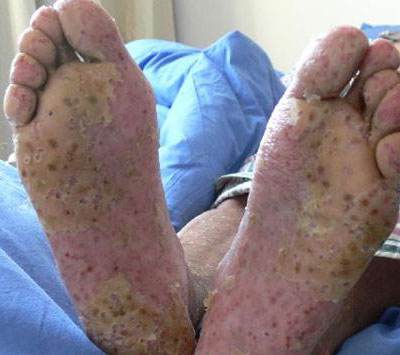 怎么区别银屑病与癣呢