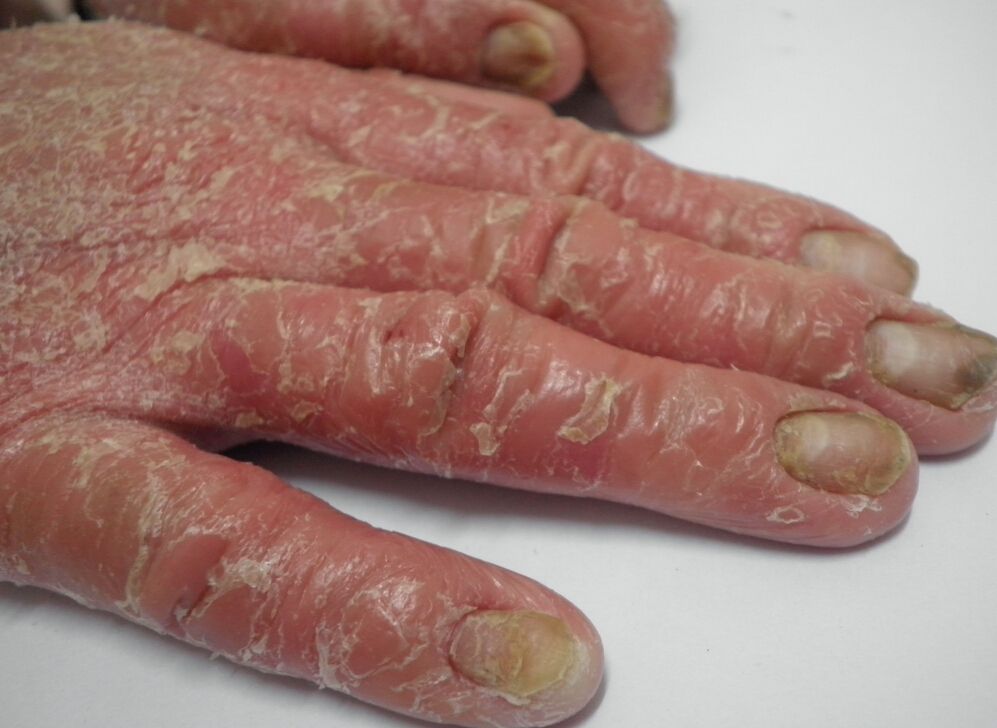 对牛皮癣患者们来说饮食上要注意什么