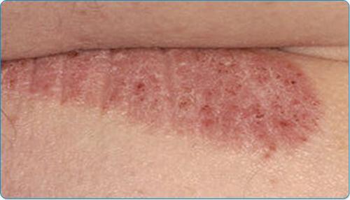 形同洪水猛兽的牛皮癣激素你还在用吗