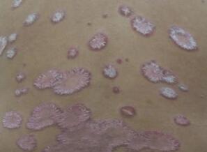 广州专家预防牛皮癣复发之用药篇