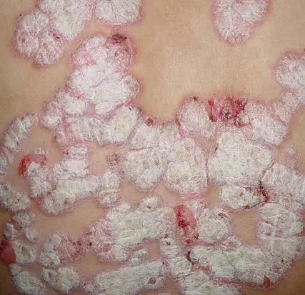 中老年牛皮癣患者饮食禁忌有哪些