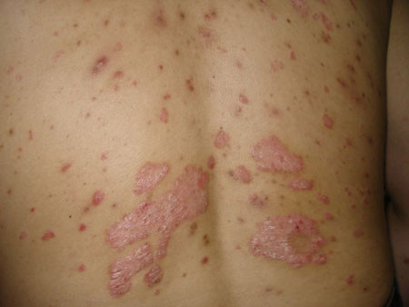 控制银屑病都有哪些好的方法