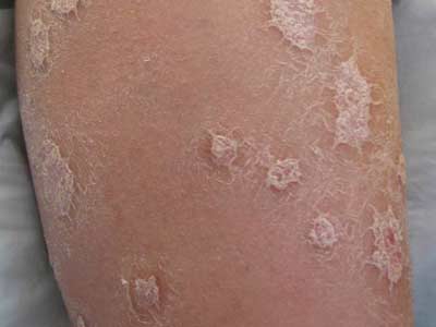 春天牛皮癣的护理保健有什么呢