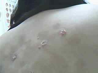 银屑病治疗需要多久时间