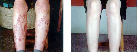 南北气候差异大对银屑病的护理有何不同