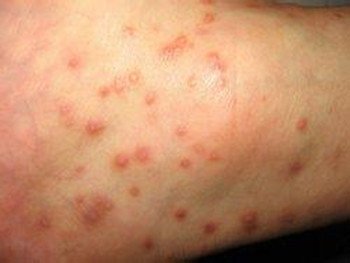 怎样才能有效预防牛皮癣的发生