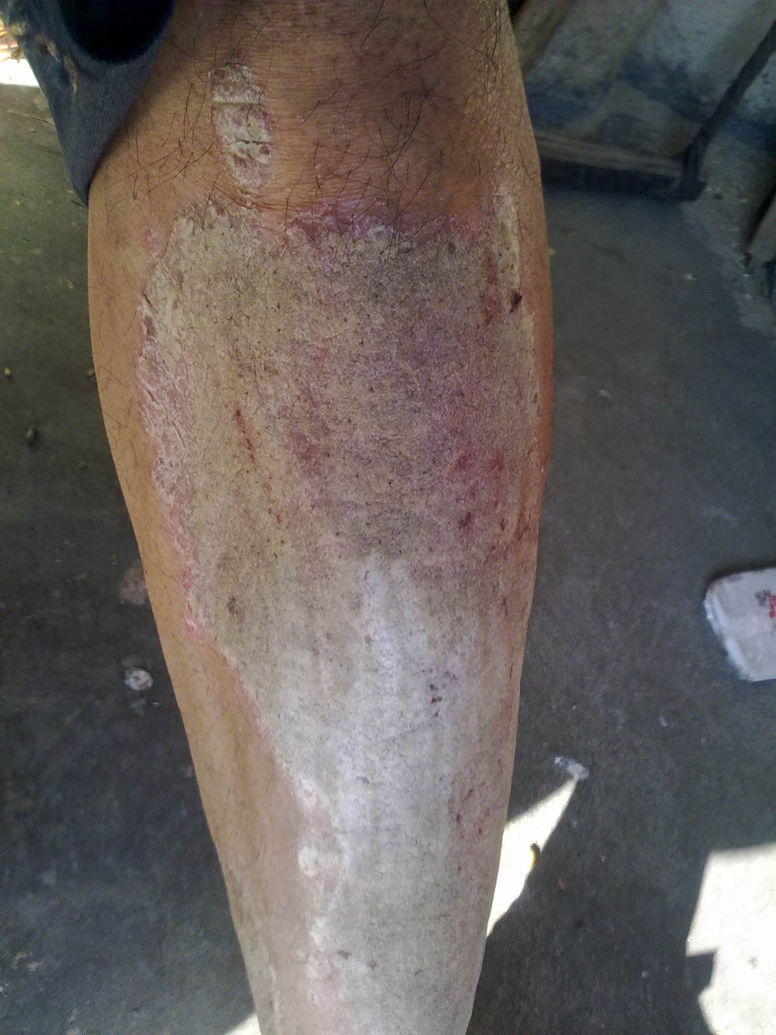 银屑病可能是什么原因引发的