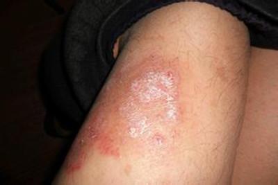 皮肤屏障受损没想到对银屑病影响这么大