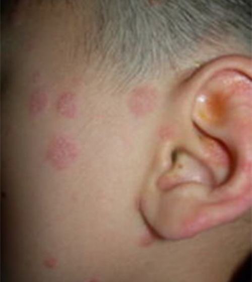 为什么牛皮癣缠上你,疾病发作的原因有哪些