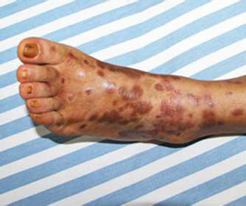 闺蜜患有牛皮癣会不会传染给我