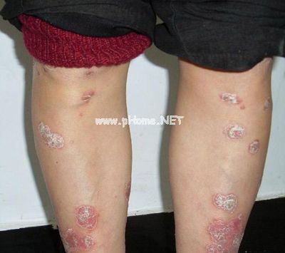 怀孕后牛皮癣要怎么护理呢？