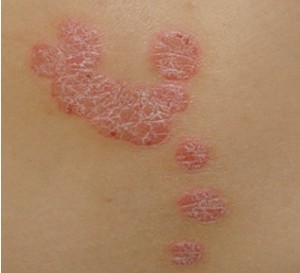 广州不同人群患上银屑病治疗有啥不同