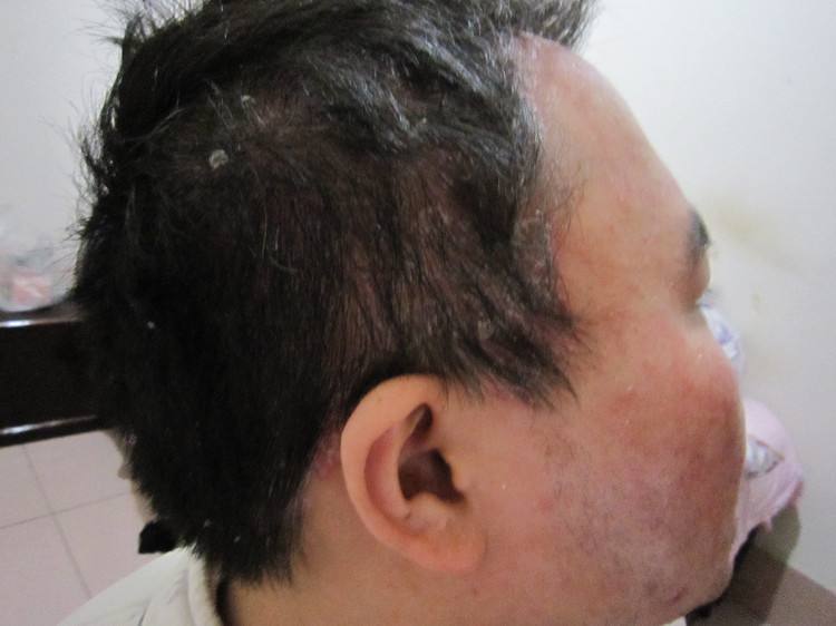 患上牛皮癣如果是比较的瘙痒要怎么做呢