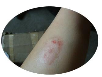 别人都不知道的牛皮癣抗复发攻略你赚了