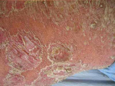 牛皮癣的发病与你的工作环境可能有关系