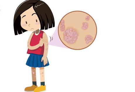 银屑病进攻身体的信号有哪些