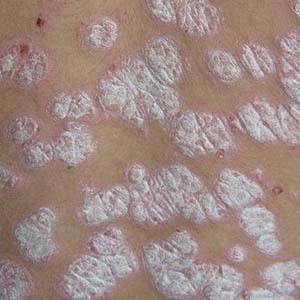 银屑病在治疗过程中有什么需要注意的吗