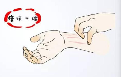 牛皮癣初期治疗能用什么药