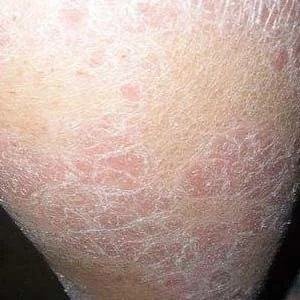 银屑病会影响寿命吗