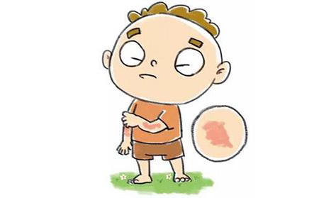 银屑病的持续治疗不等于药不能停