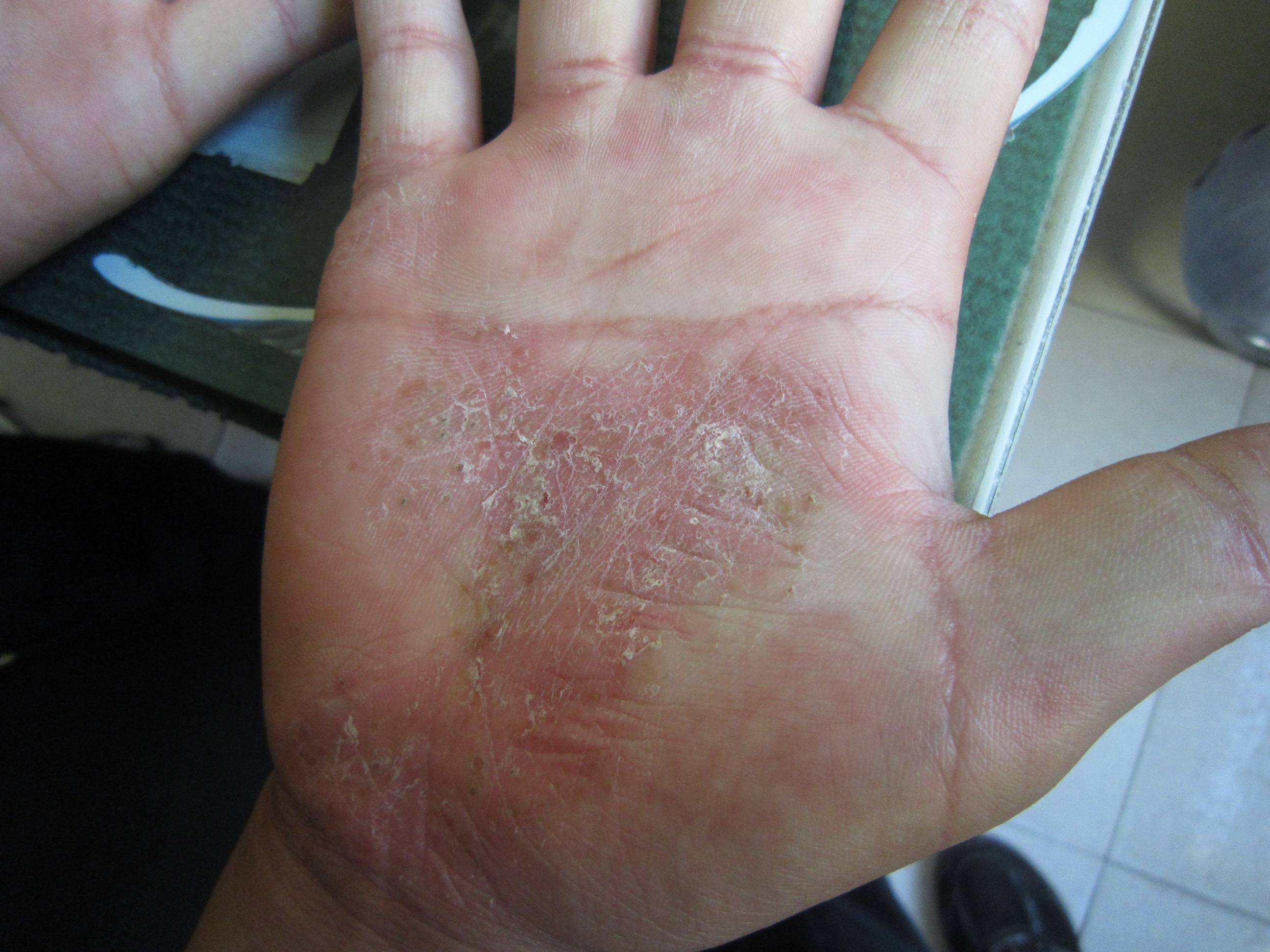 吃蘑菇会让牛皮癣复发吗