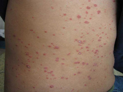 白醋是针对银屑病的克星吗